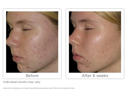 Glytone Acne Self-Foaming Cleanser
