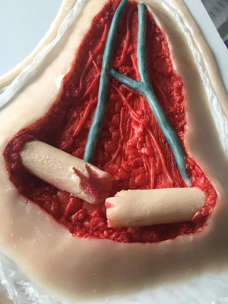 Open Collarbone Wound Prosthetic