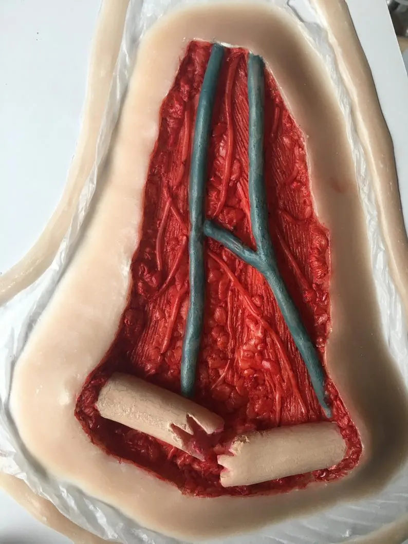 Open Collarbone Wound Prosthetic