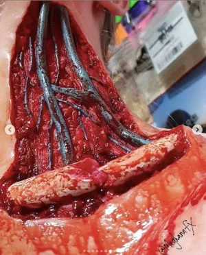 Open Collarbone Wound Prosthetic