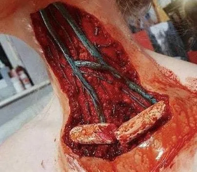 Open Collarbone Wound Prosthetic