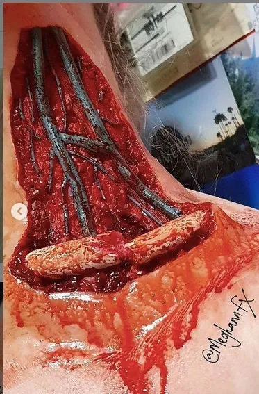 Open Collarbone Wound Prosthetic