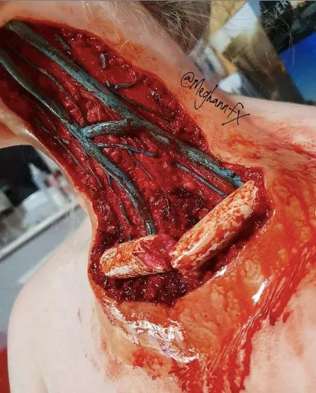 Open Collarbone Wound Prosthetic