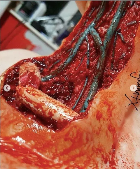 Open Collarbone Wound Prosthetic