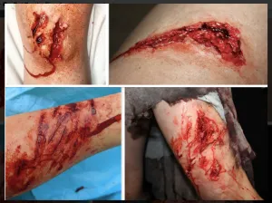 Outdoor Injuries Prosthetic Bundle